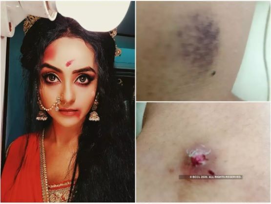 Ishita Ganguly Draupadi injuries