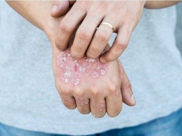 Home Remedies for Psoriasis	