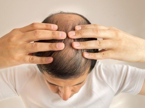 Ginger for hair baldness