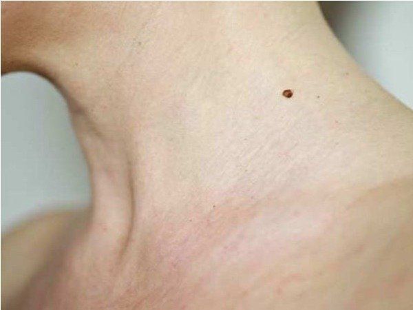 Mole on body