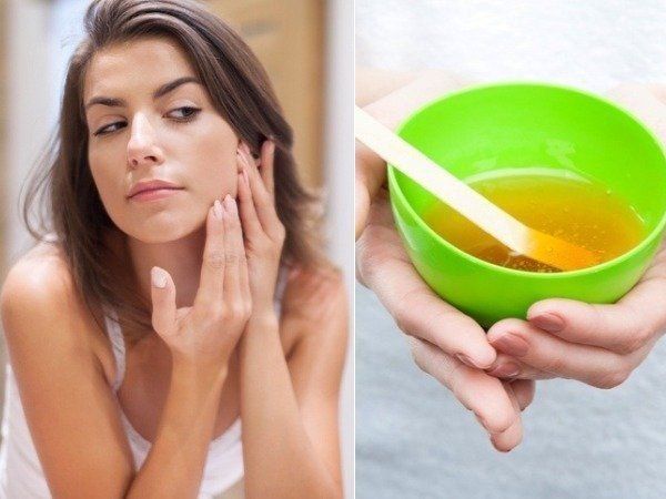  Home remedies to get rid of acne scars on face