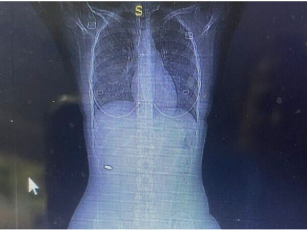Woman back pain due to bullet stuck in spine from 3 months Know About Truth 