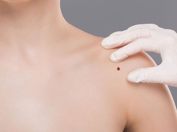 Birth mark Sign, Astrology For Birthmark, Astro Tips For Body Birthmark, Body Birthmark Meaning,