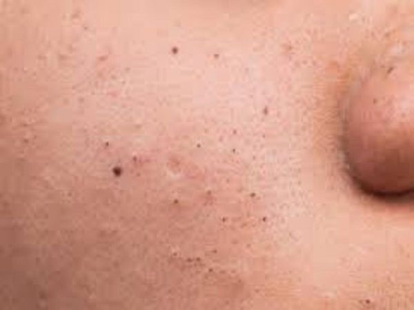 Blackheads Removal Tips
