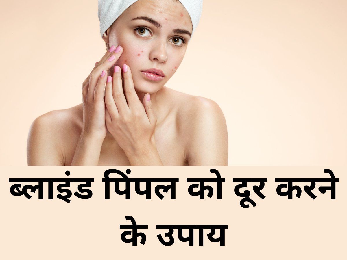 Blind Pimple: चेहरे की खूबसूरती बिगाड़ते हैं ब्लाइंड पिंपल, दूर करने के लिए अपनाएं घरेलू उपाय