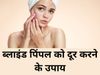 How To Remove Blind Pimple