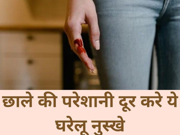 Blister Remedies In Hindi, how to get rid of blood blisters