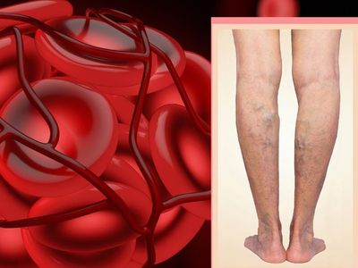 Blood Clotting Blood Clotting