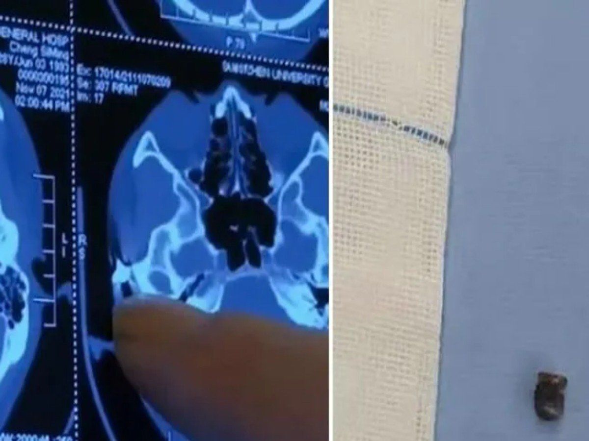 20 साल से सिर में 'मौत' लेकर घूम रहा था शख्स, तेज दर्द से खुला काफी चौंकाने वाला राज