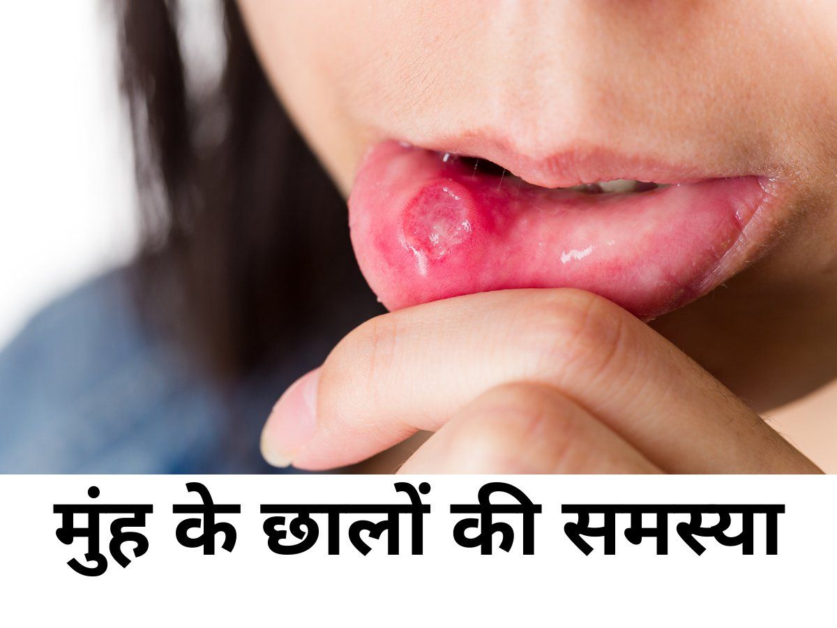 mouth-ulcers-explained-in-hindi-muh-me