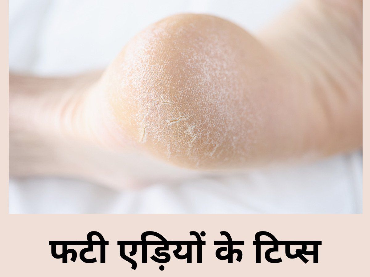 Cracked Heels Reason: Vitamins Are Causes Of Cracked Heels - बेमौसम फट ...