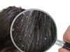 Remedies For Dandruff