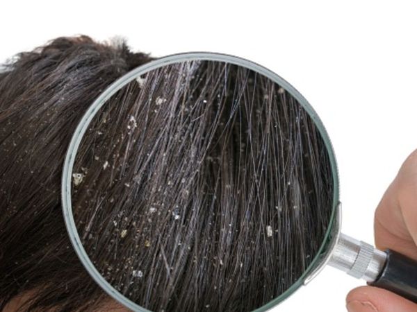 Remedies For Dandruff