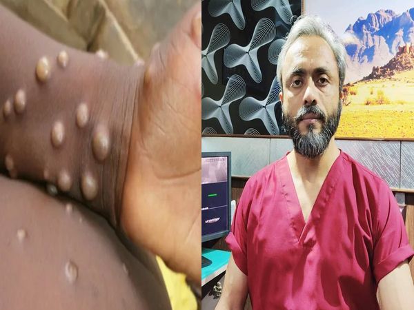 What is monkeypox virus, how dangerous is it, how is it spread and what is the treatment? Know from Dr Anshuman Kumar