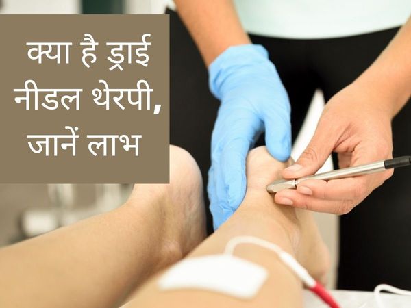 What Is Dry Needle Therapy, How Dry Needle Therapy  Effective In Muscles Pain, Dry Needle Therapy, Dry Needle Therapy benefits, Dry Needle Therapy side effects, Dry Needle Therapy cost, ड्राई नीडल थेरेपी क्या है, ड्राई नीडल थेरेपी दर्द दूर करने में कैसे ह