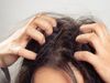 Dry scalp remedies