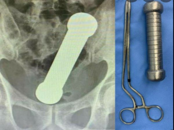 2 kg dumbbell stuck in man private part in brazil know about shocking truth