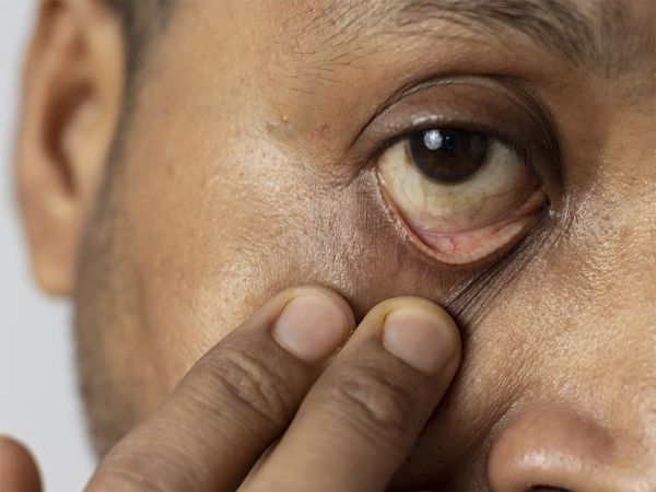 Yellow Fungus in ghaziabad,Yellow Fungus symptoms