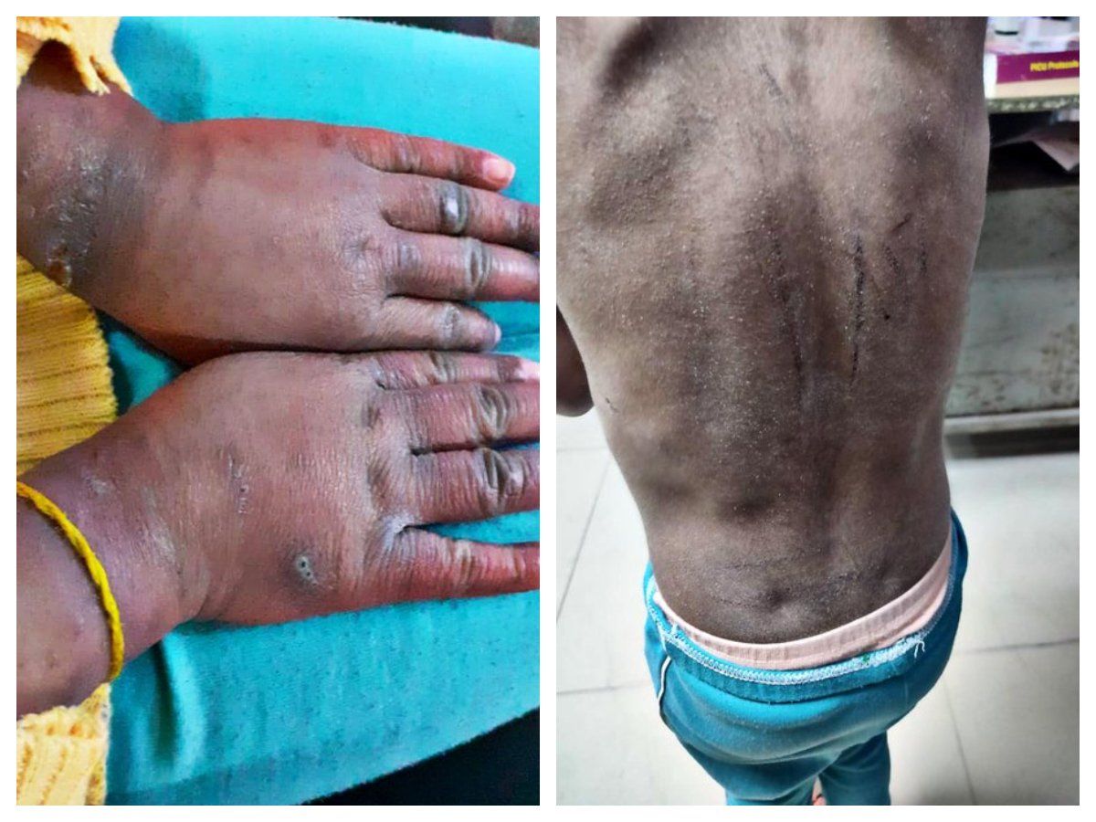 रूह कंपा देने वाला है सौतेली मां का 8 साल के बच्चे के साथ व्यवहार, शरीर के कई चोटों के निशान, सूजे हुए हाथ