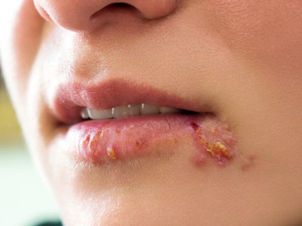  Herpes Remedies