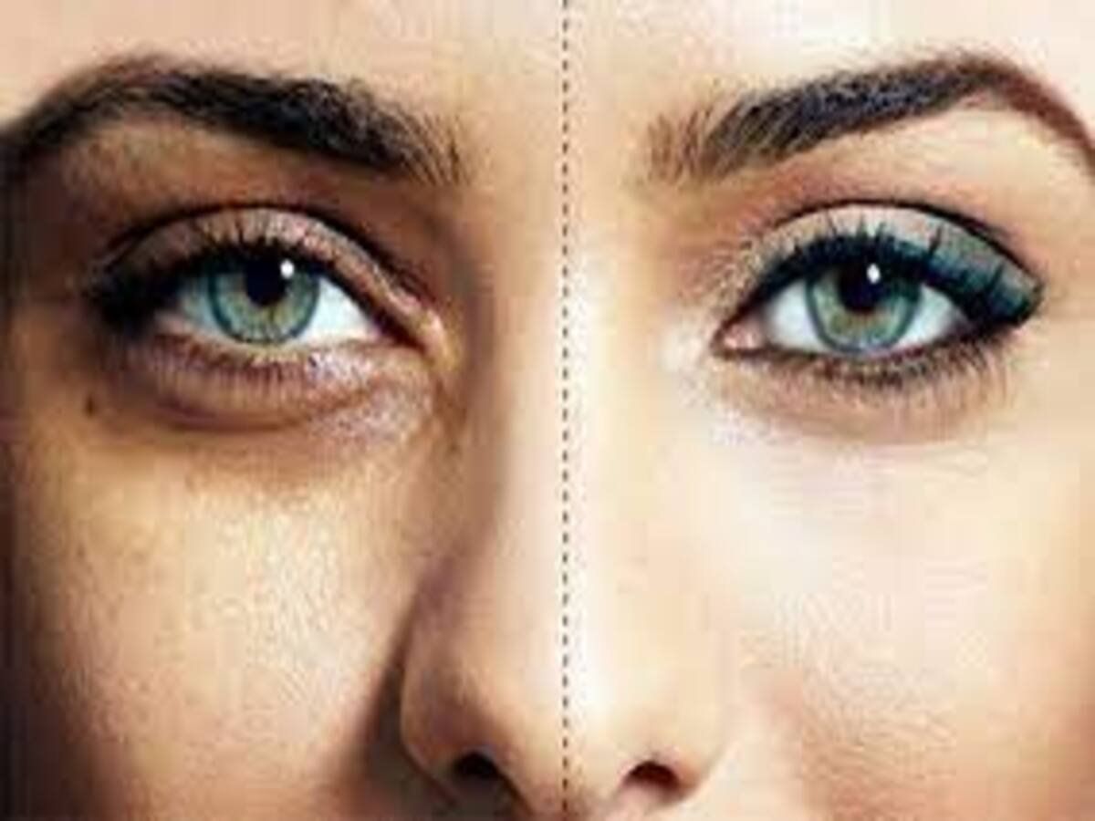 Home Remedies Tips For Dark Circles these reasons can cause dark circles