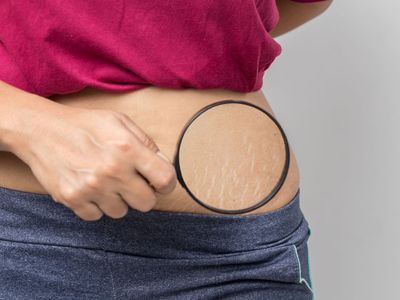Tips to remove stretch marks