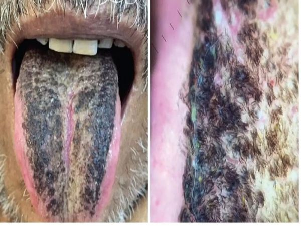 Man's tongue turned black and hair grew, know how and why this happened
