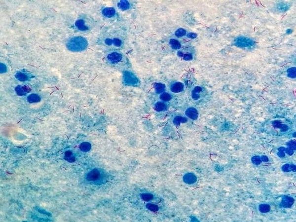 Ghana officially confirmed two cases of the Marburg virus a highly infectious disease similar to Ebola