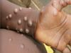  Suspected monkeypox case in Kerala, samples of traveller from UAE sent for testing