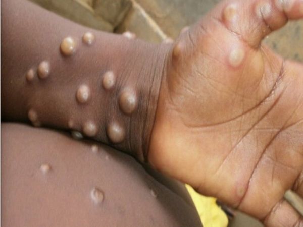  Suspected monkeypox case in Kerala, samples of traveller from UAE sent for testing