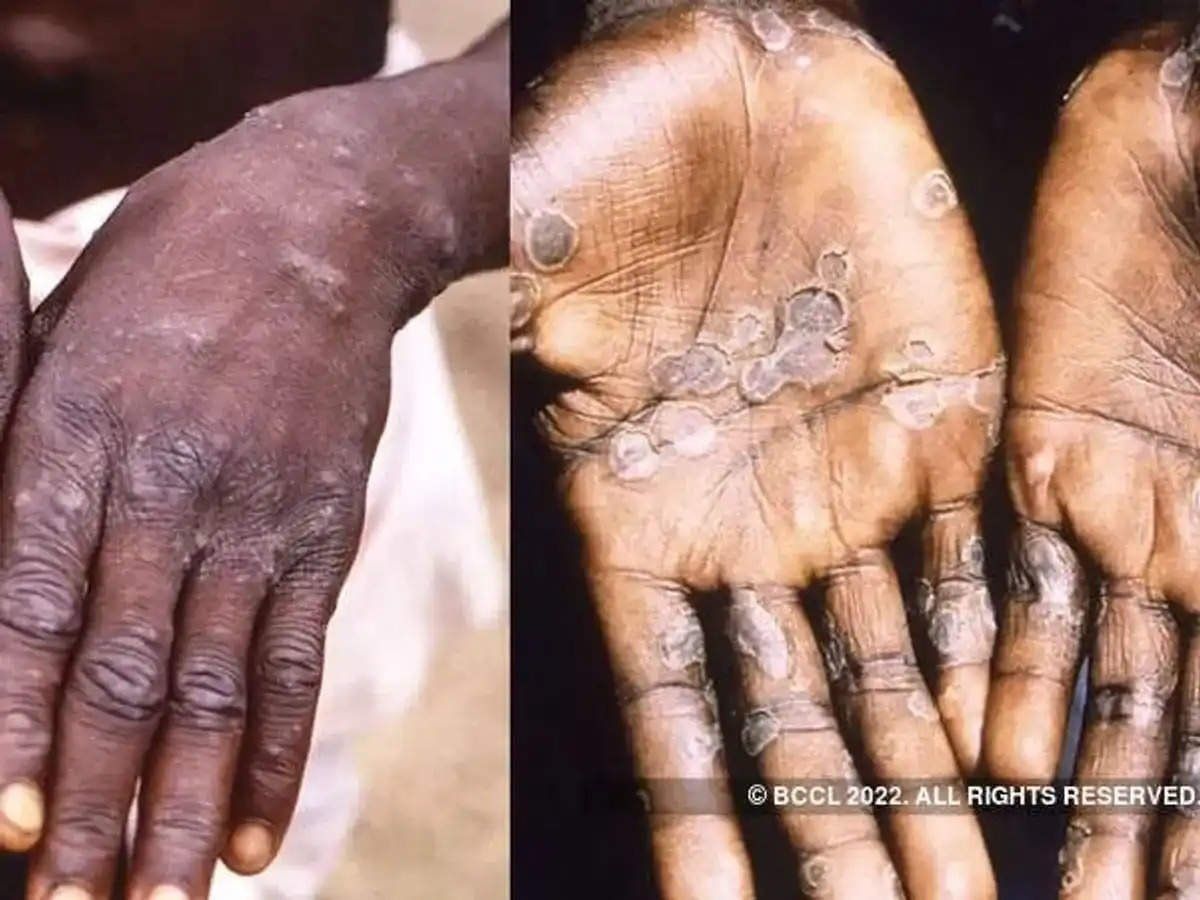 Monkeypox Cases In India: देश में मंकीपॉक्स के दूसरे केस की हुई पुष्टि, केरल में ही मिला दूसरा मामला