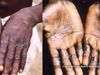 Kerala reports second monkeypox case health minister Veena George confirmed 