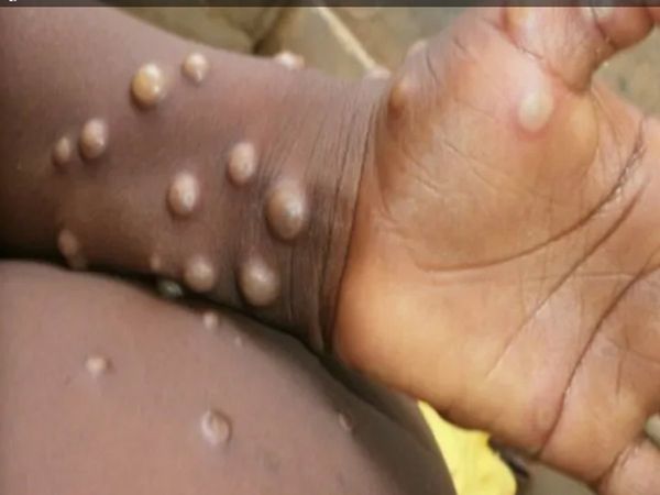 Suspected case of monkeypox found in Noida, 4 cases in India so far