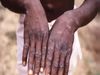 Third case of Monkeypox reported in Kerala confirmed infection in a person who returned from UAE