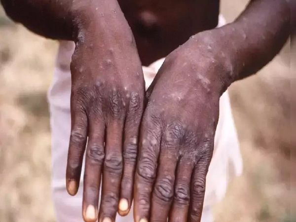 Third case of Monkeypox reported in Kerala confirmed infection in a person who returned from UAE