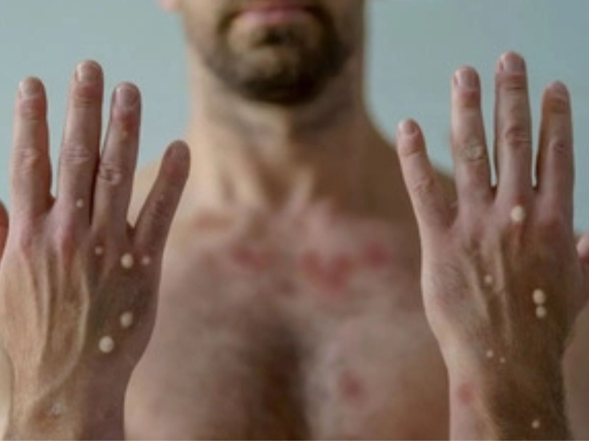 Monkeypox spread: क्या शारीरिक संबंध बनाने से भी फैल सकता है मंकीपॉक्स, जानें क्या कहते हैं इस मामले में एक्सपर्ट