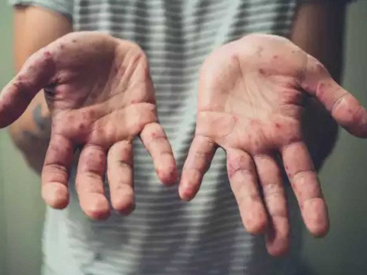 Monkeypox Symptoms in Hindi: बच्चों में मंकीपॉक्स वायरस का खतरा ज्यादा, इन लक्षणों पर रहें एकदम अलर्ट