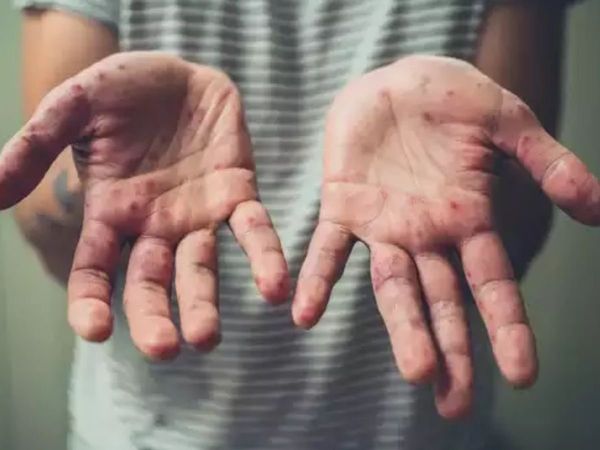 Monkeypox outbreak 2022, Monkeypox outbreak, Monkeypox New 2022, Monkeypox outbreak New, monkeypox cases in india, मंकीपॉक्स संक्रमण, मंकीपॉक्स संक्रमण 2022, मंकीपॉक्स संक्रमण न्यूज, मंकीपॉक्स 2022, मंकीपॉक्स संक्रमण की खबर