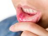 Mouth Ulcers Remedies