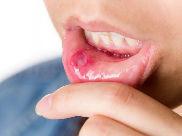 Mouth Ulcers Remedies