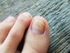 Fungal Nail