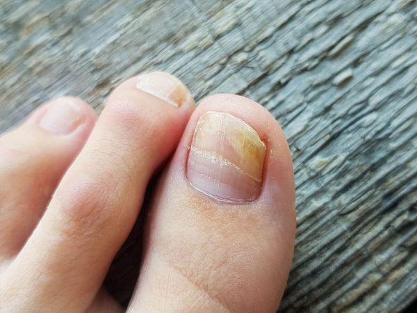 Fungal Nail
