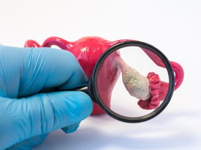 PCOS Remedies PCOS Remedies