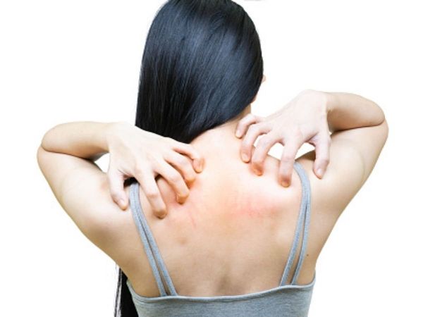 Prickly Heat Remedies