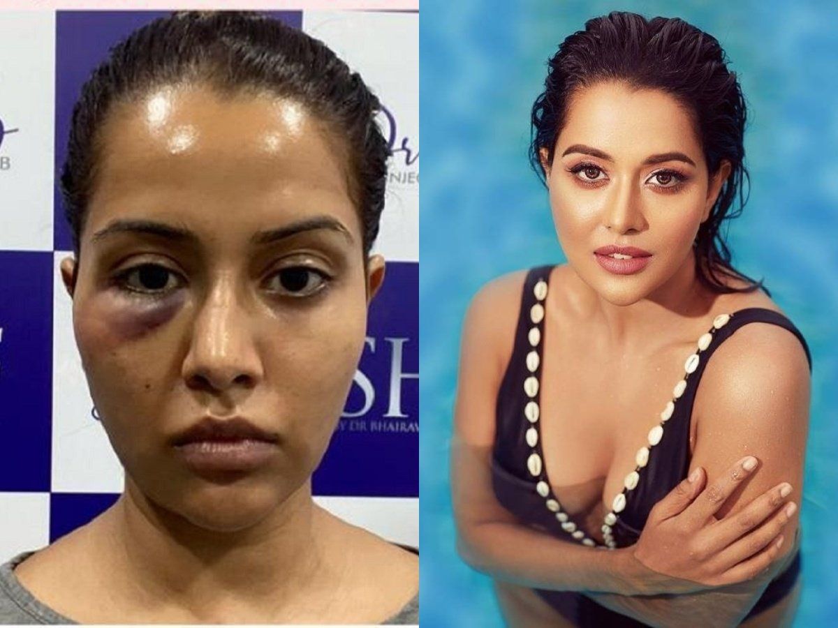 Raiza Wilson: गलत इलाज से खूबसूरत चेहरे का ये हाल, एक्ट्रेस का आरोप- डॉक्टर ने जबरदस्ती किया ट्रीटमेंट!