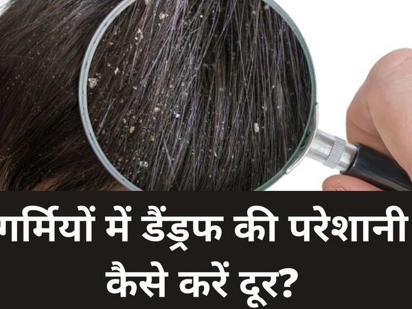 Remedies for Dandruff