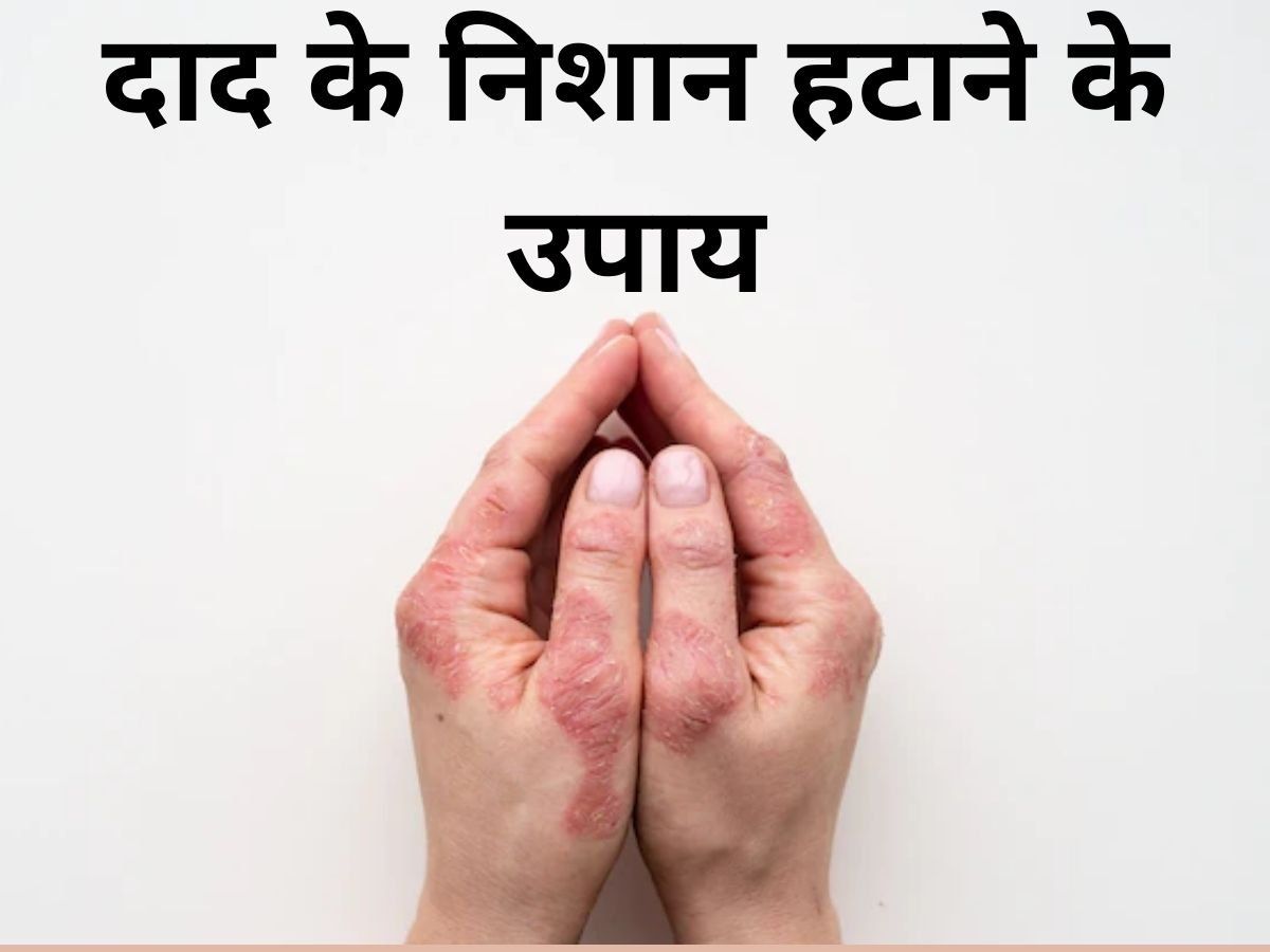 Remedies for Ringworm Scars home remedies to remove ringworm scars