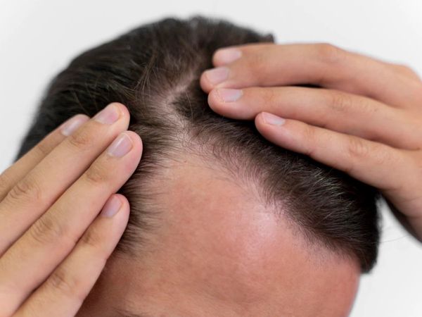 Remedies for white hair