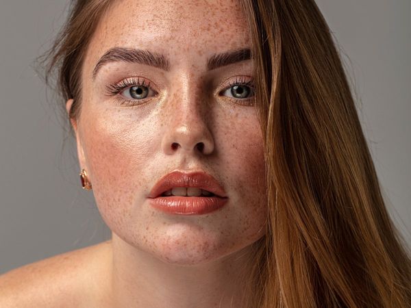 Remedies to remove freckles