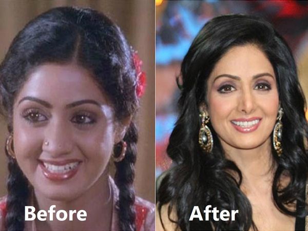 Actresses who got nose cosmetic surgery